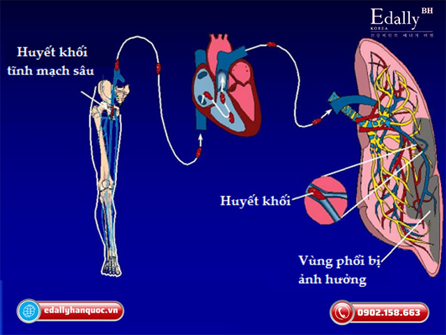 Nhồi máu phổi hay còn gọi là thuyên tắc phổi