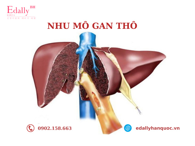 Nhu mô gan thô