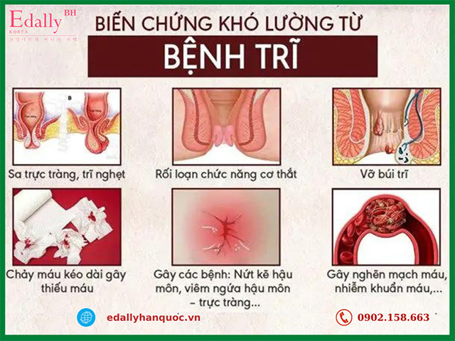 Những biến chứng nguy hiểm của bệnh trĩ