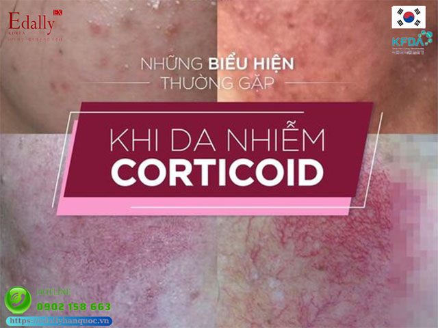 Những dấu hiệu thường gặp khi da bị nhiễm Corticoid