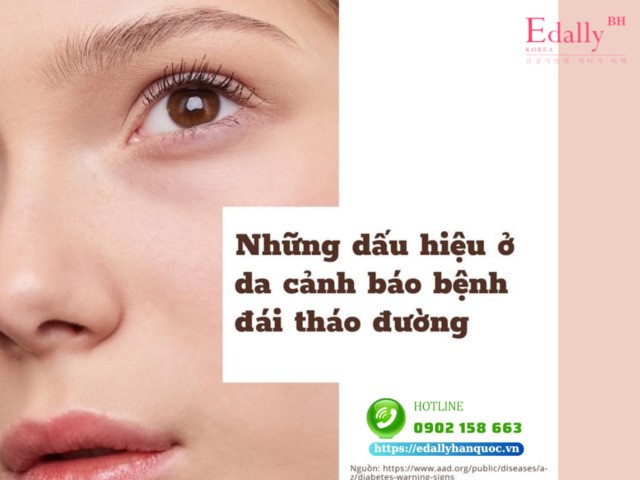 Những dấu hiệu ở da cảnh báo bệnh đái tháo đường