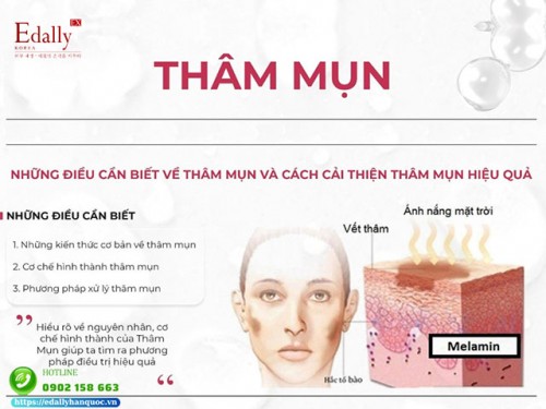 Thâm Mụn Và Cách Cải Thiện Thâm Mụn Hiệu Quả