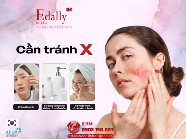 Những điều cần tránh khi peel da tại nhà bị bỏng