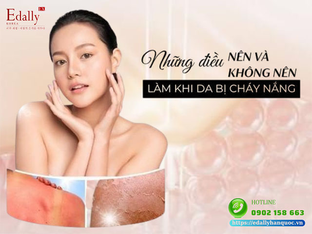 Những điều nên và không nên làm khi da bị cháy nắng