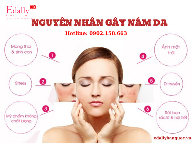 Những nguyên nhân gây nám da là gì?