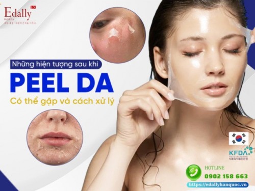 Những Phản Ứng Có Thể Gặp Sau Peel Da Và Cách Xử Lý