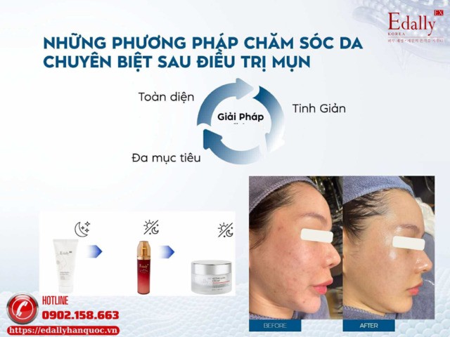 Giải pháp kiểm soát và ngăn ngừa mụn tái phát chuẩn y khoa từ Mỹ phẩm Edally EX