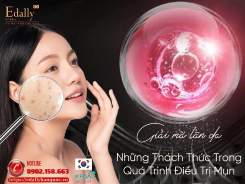 Những Thách Thức Trong Quá Trình Điều Trị Mụn 