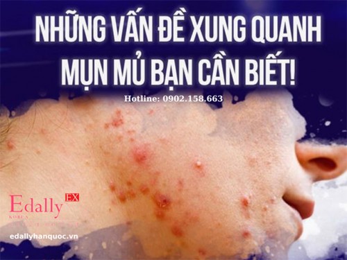 Mụn Mủ Là Gì? Nguyên Tắc Điều Trị Mụn Mủ?