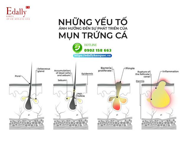 Những yếu tố gây mụn trứng cá