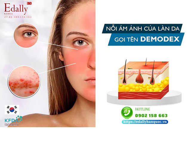 Nỗi ám ảnh của làn da nhiễm corticoid gọi tên demodex