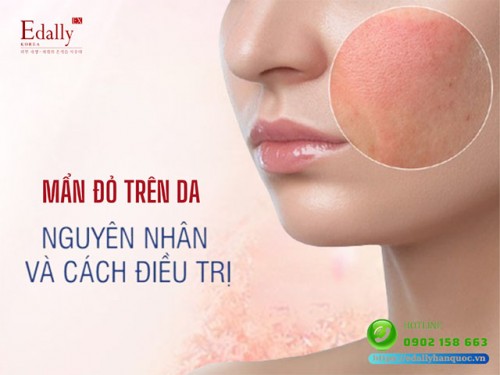 Da Hay Bị Mẩn Đỏ - Nguyên Nhân Và Cách Xử Trí 