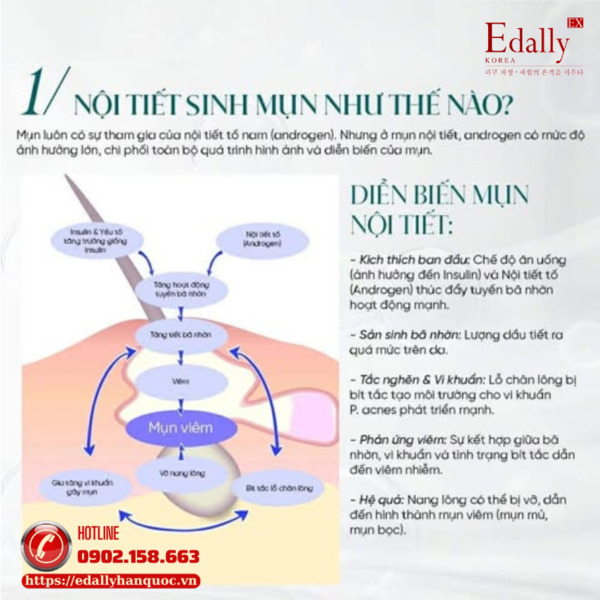 Diễn biến sinh mụn nội tiết?