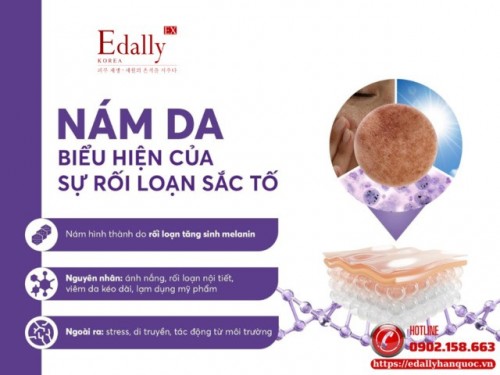Hướng Dẫn Tư Duy Điều Trị Nám Da Từ Chuyên Gia