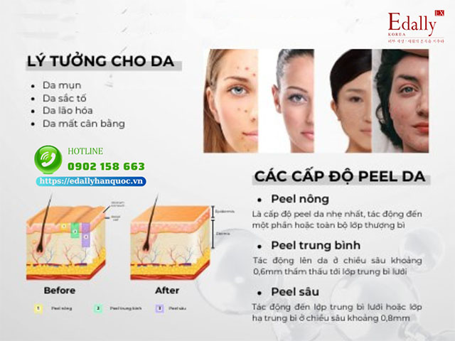 Peel da có mấy cấp độ và lý tưởng cho loại da nào?