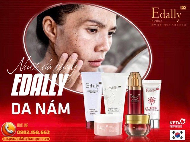 Routine chăm sóc da nám sau sinh hiệu quả và không tái phát