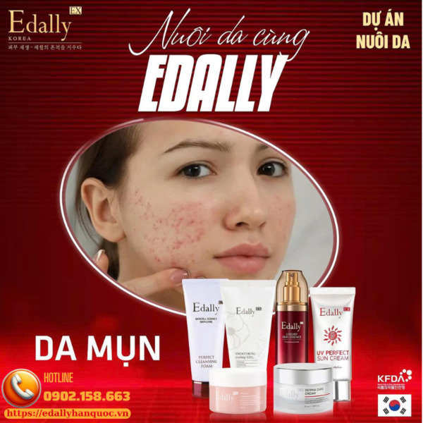 Routine chăm sóc da sau điều trị mụn viêm nặng Routine chăm sóc da sau điều trị mụn viêm nặng