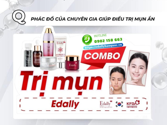 Routine skincare điều trị dứt điểm mụn ẩn tại nhà khoa học