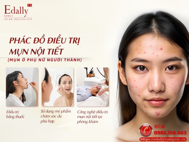Phác đồ điều trị mụn ở phụ nữ trưởng thành