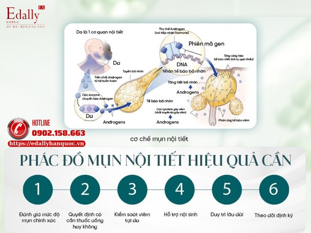Phác đồ mụn nội tiết hiệu quả cần những gì?
