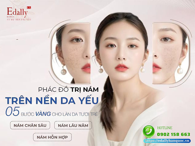 Phác đồ trị nám trên nền da yếu với 5 bước vàng cho làn da tươi trẻ