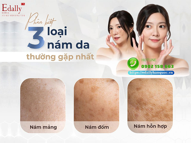 Cách phân biệt 3 loại nám da: Nám mảng - Nám đốm - Nám hỗn hợp