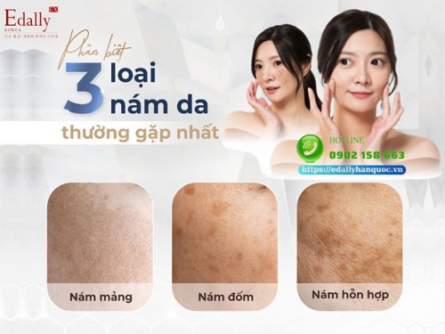 Phân Biệt 3 Loại Nám Da: Nám Mảng - Nám Đốm - Nám Hỗn Hợp 