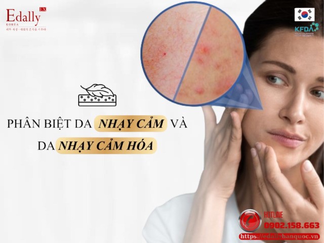 Cách phân biệt da nhạy cảm và da nhạy cảm hoá để chăm sóc da hiệu quả