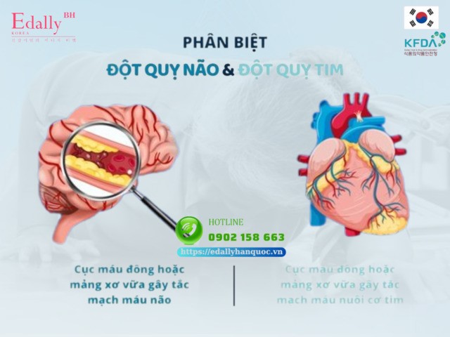 Phân biệt đột quỵ não và đột quỵ tim 