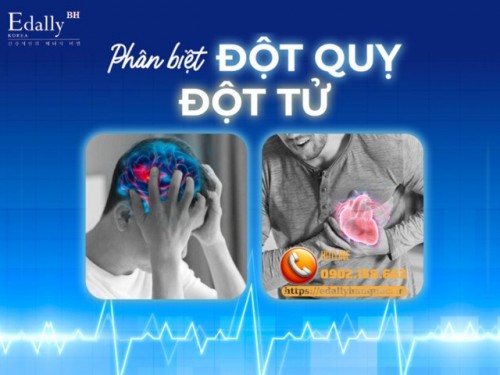 Phân Biệt Đúng Đột Tử Và Đột Quỵ Để Sơ Cứu Đúng Cách