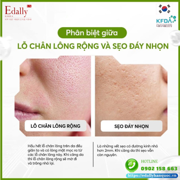 Phân biệt lỗ chân lông rộng và sẹo đáy nhọn