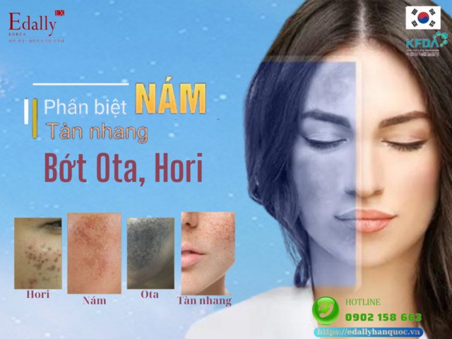 Cách phân biệt nám da, tàn nhang, bớt Hori, bớt Ota và cách điều trị hiệu quả