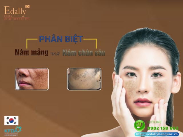 Phân biệt nám nông và nám sâu