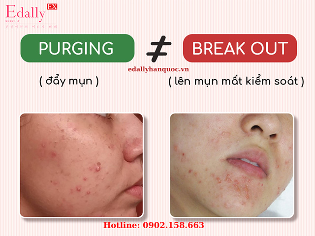 Phân biệt Purging và Breakout khi skincare