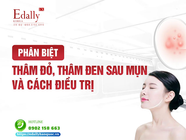 Phân biệt thâm đỏ, thâm đen sau mụn và phương pháp điều trị