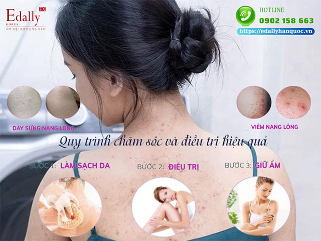 Cách phân biệt bệnh viêm nang lông và dày sừng nang lông