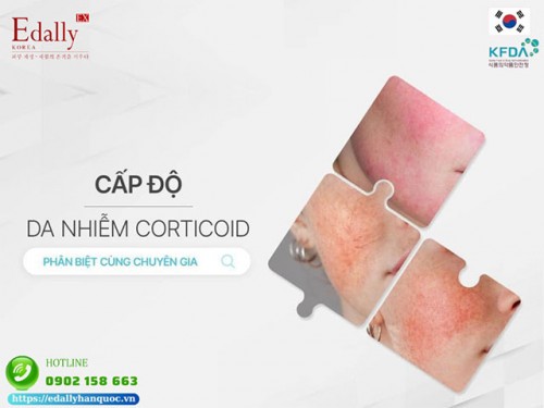 Phân Loại Cấp Độ Da Nhiễm Corticoid