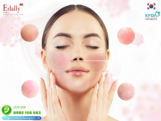 Phân Loại Da Nhạy Cảm Để Chăm Sóc Da Hiệu Quả