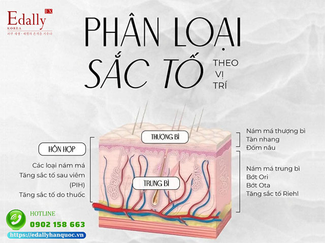 Phân loại tăng sắc tố da theo vị trí