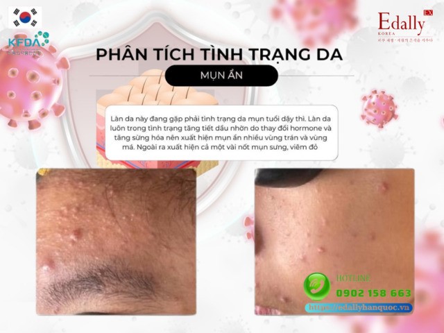 Case lâm sàng tình trạng làn da bị mụn ẩn