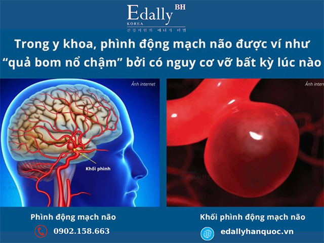 Túi phình động mạch não được ví như quả bom nổ chậm bởi có thể vỡ bất cứ lúc nào và tỉ lệ tử vong do vỡ túi phình Ðộng mạch não lên tới 45%