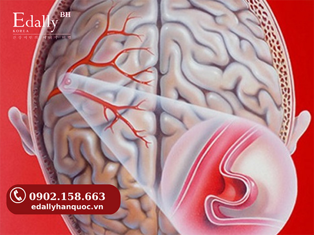 Nguyên nhân gây phình mạch máu não là do bị dị dạng mạch máu não