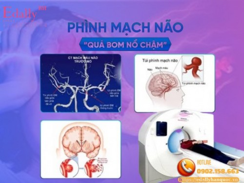Phình Mạch Nội Sọ Và Các Con Số Đáng Lưu Ý
