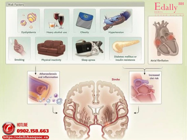 Phòng ngừa thứ phát sau đột quỵ nhồi máu não Phòng ngừa thứ phát sau đột quỵ nhồi máu não