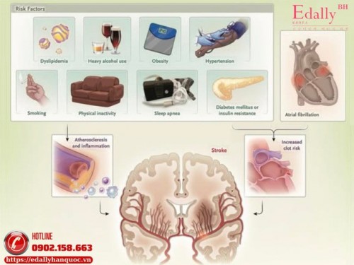 Phòng Ngừa Thứ Phát Sau Đột Quỵ Nhồi Máu Não
