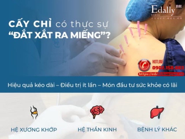 Phương pháp cấy chỉ có thực sự đắt xắt ra miếng?