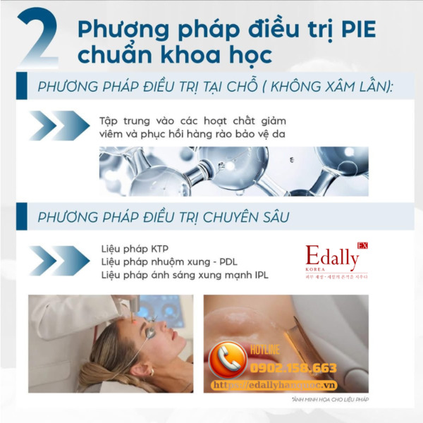 Cách điều trị Hồng ban sau viêm (PIE) chuẩn khoa học