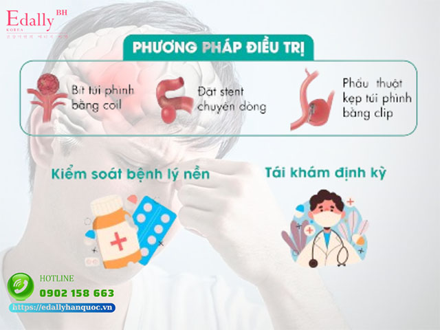 Cách điều trị túi phình mạch máu não