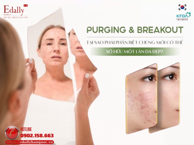 Purging Và Breakout - Tại Sao Phải Phân Biệt Chúng Mới Có Thể Sở Hữu Một Làn Da Đẹp?