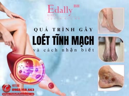 Quá Trình 4 Bước Gây Loét Tĩnh Mạch Và Cách Nhận Biết
